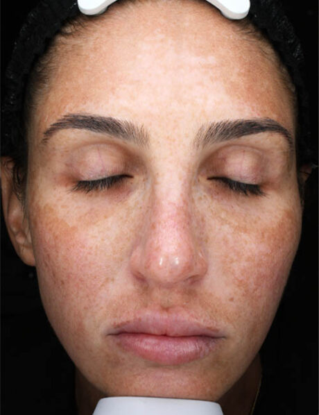 Chemical Peel case #5507