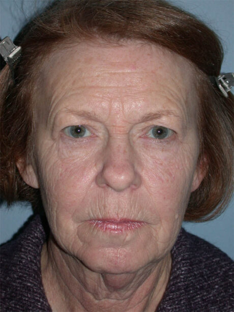 Blepharoplasty case #4948