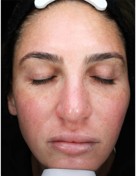 Chemical Peel case #5507