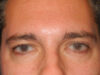 Blepharoplasty case #5270