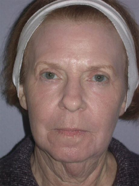 Blepharoplasty case #4948