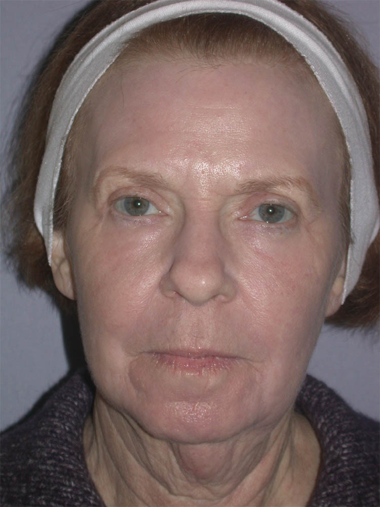 Blepharoplasty case #6468