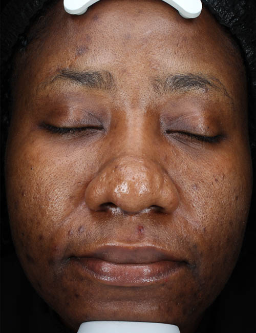 _0002_Zinnieh chemical peel-after.JPG