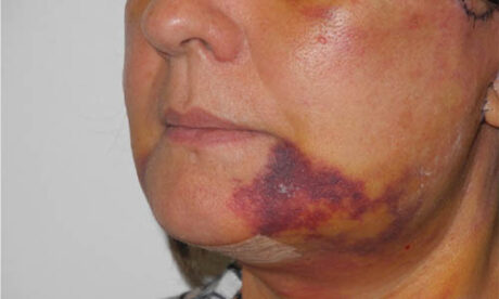 V-Beam Post Surgical Bruising case #5501