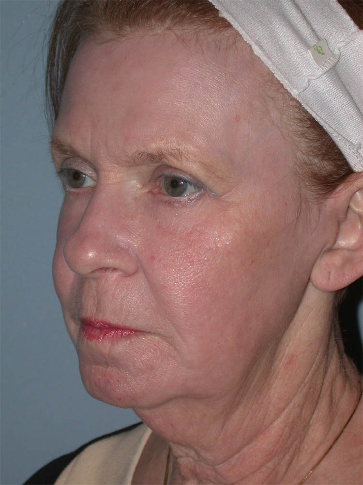 CO2 Laser Resurfacing case #4948