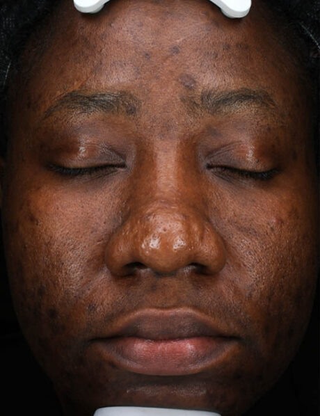 Chemical Peel case #5510