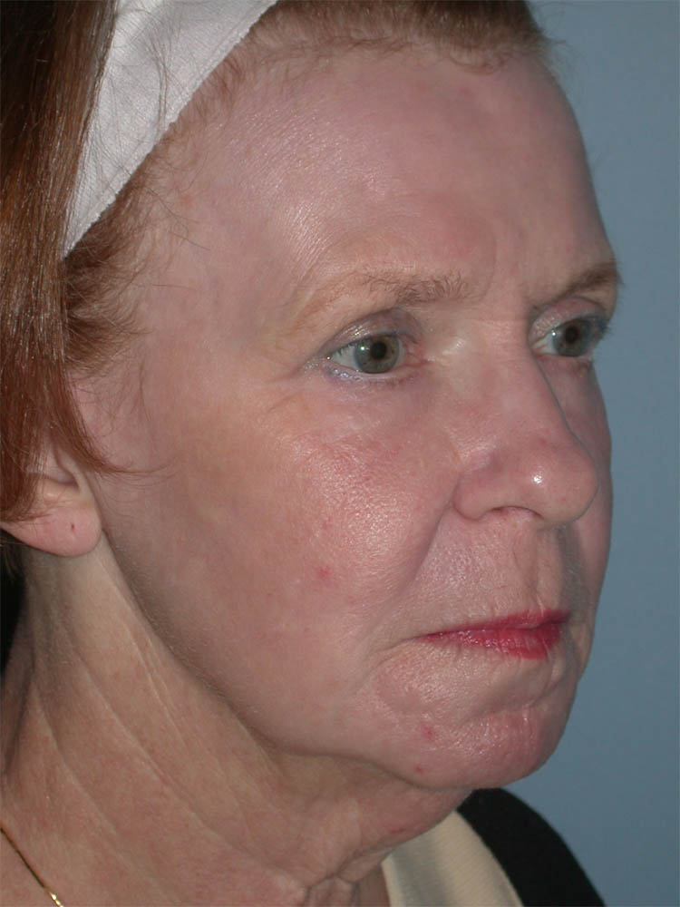 Blepharoplasty case #4948