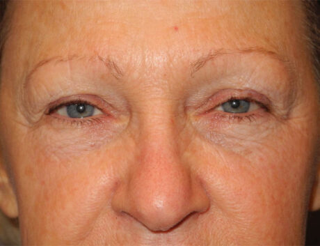 Blepharoplasty case #5153