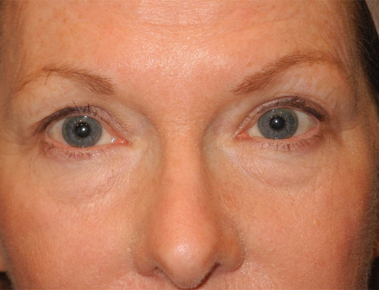 Blepharoplasty case #4966