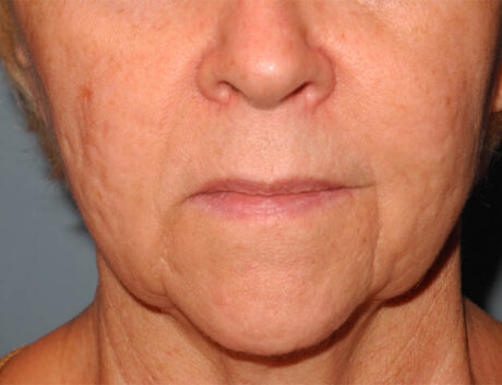 Facelift case #4986