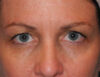 Blepharoplasty case #4960