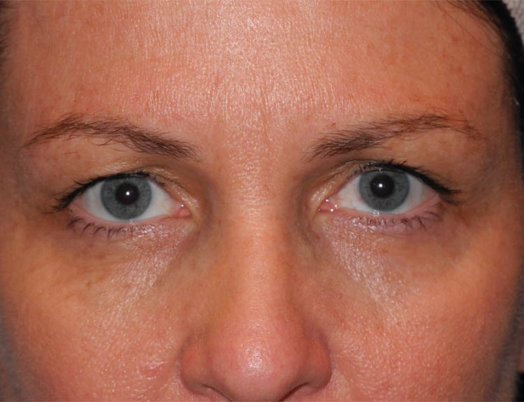 Blepharoplasty case #4960