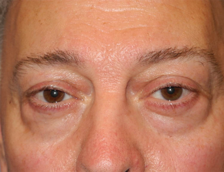 Blepharoplasty case #5148