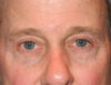 Blepharoplasty case #6464