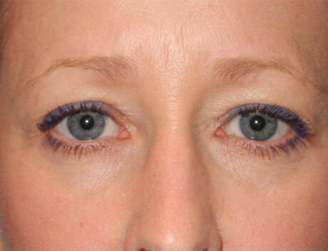 Blepharoplasty case #6465