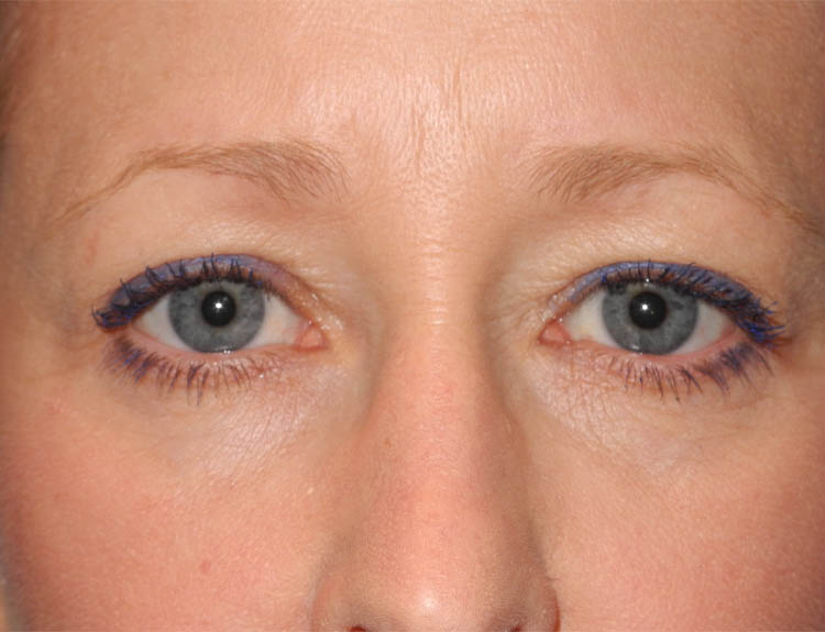 Blepharoplasty case #5003