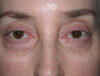 Blepharoplasty case #4858