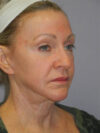 CO2 Laser Resurfacing case #4681