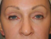 CO2 Laser Resurfacing case #4681