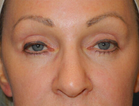 Blepharoplasty case #5153