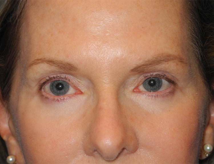 Blepharoplasty case #4966