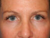 Blepharoplasty case #4960