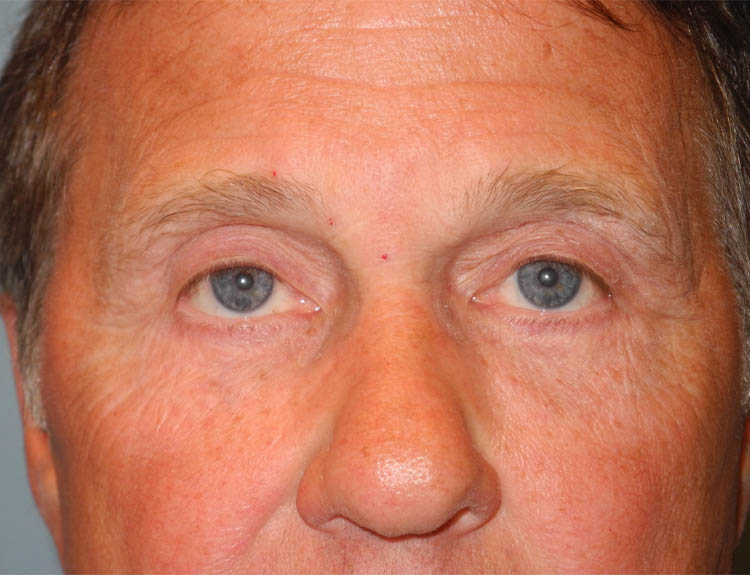 Blepharoplasty case #5018