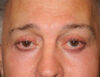 Blepharoplasty case #5148