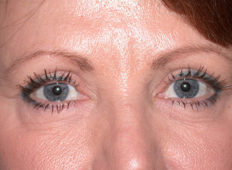 Blepharoplasty case #4819