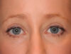 Blepharoplasty case #5003