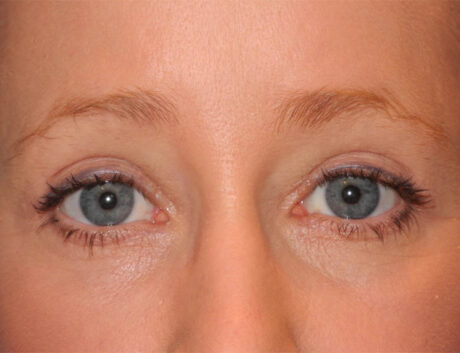 Blepharoplasty case #6465