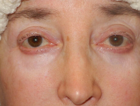 Blepharoplasty case #4858