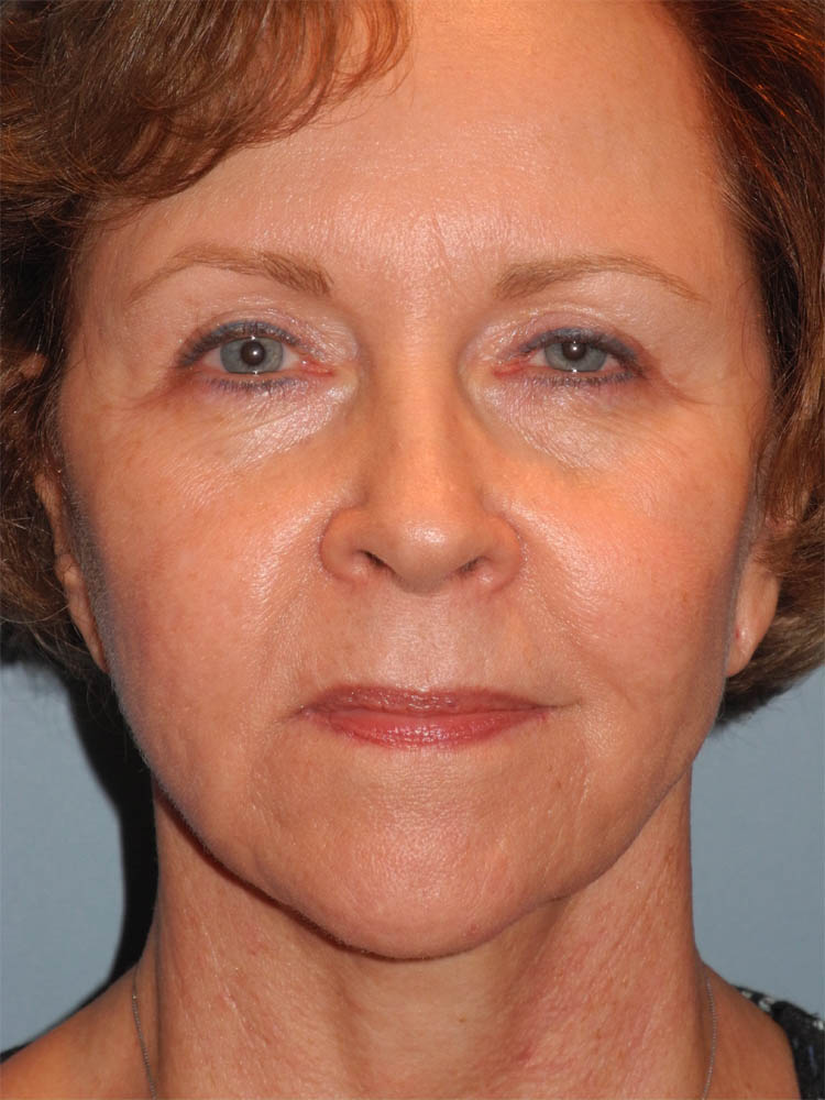 Blepharoplasty case #4986