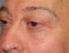 Blepharoplasty case #5148