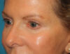 Blepharoplasty case #4966