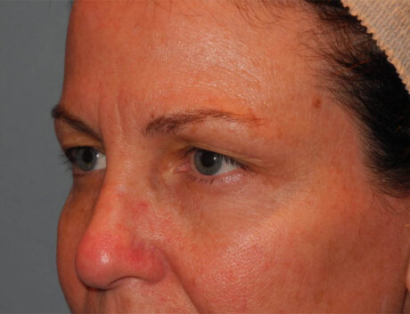 Blepharoplasty case #4960