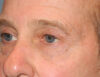 Blepharoplasty case #5018