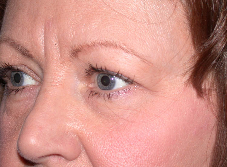 Blepharoplasty case #4819