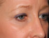 Blepharoplasty case #6465