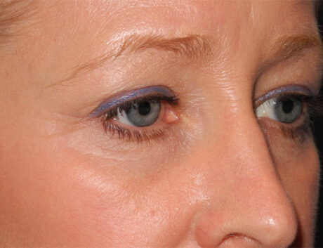 Blepharoplasty case #5003