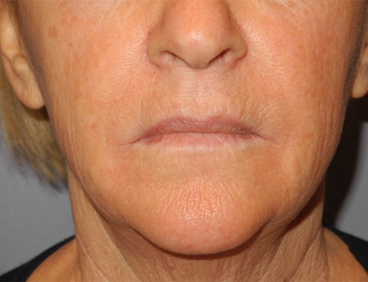 CO2 Laser Resurfacing case #4681