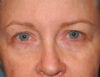 Blepharoplasty case #4986