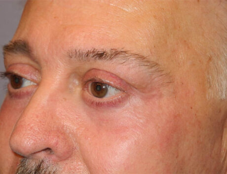 Blepharoplasty case #5148