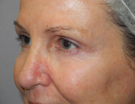 Blepharoplasty case #4960