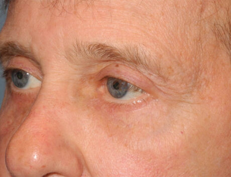 Blepharoplasty case #6464