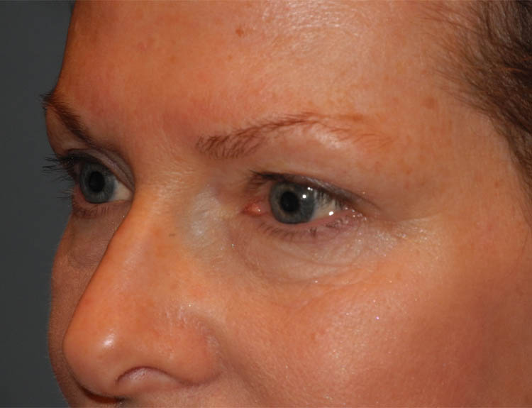 Blepharoplasty case #4966