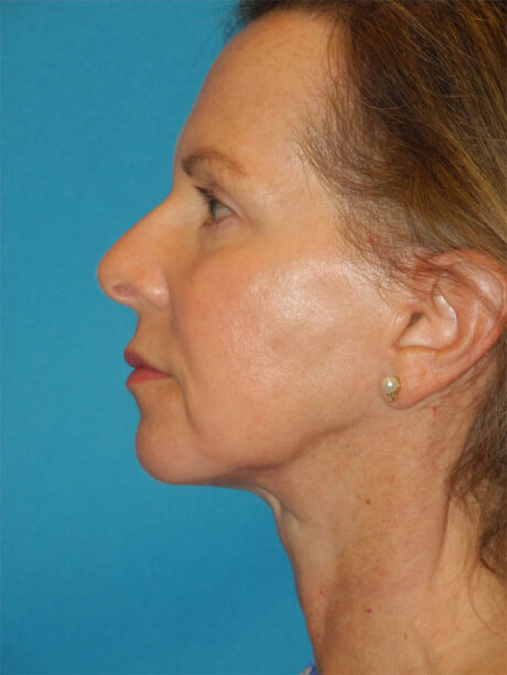 Blepharoplasty case #4966