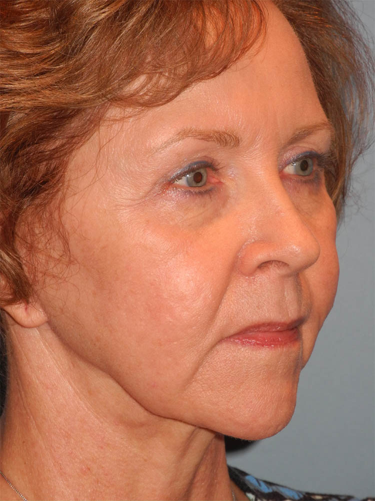 Blepharoplasty case #6466