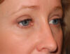 Blepharoplasty case #6465