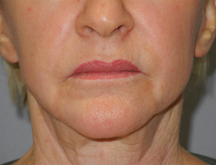 CO2 Laser Resurfacing case #4681